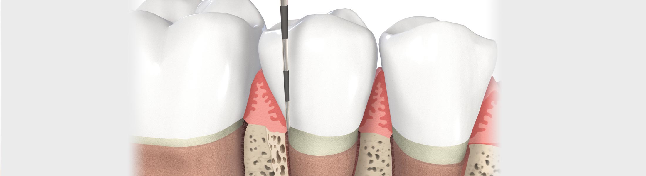 Parodontologie_behandlung_1